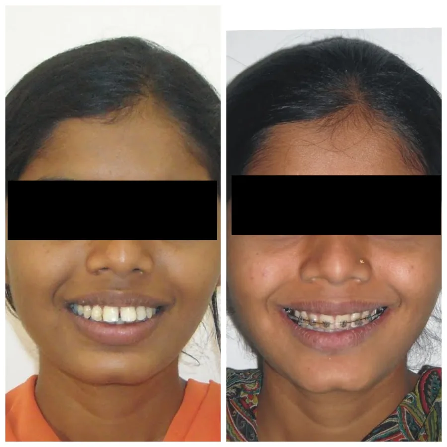 Smile-Right-Patientswebp-3