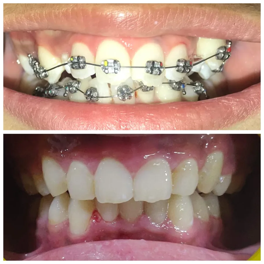 Smile-Right-Patientswebp-4