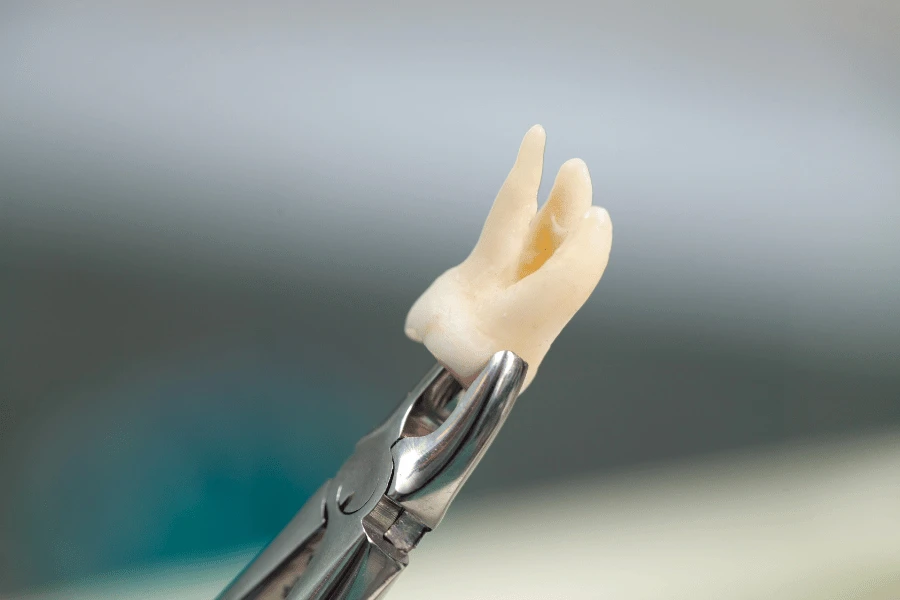 Tooth Extractions